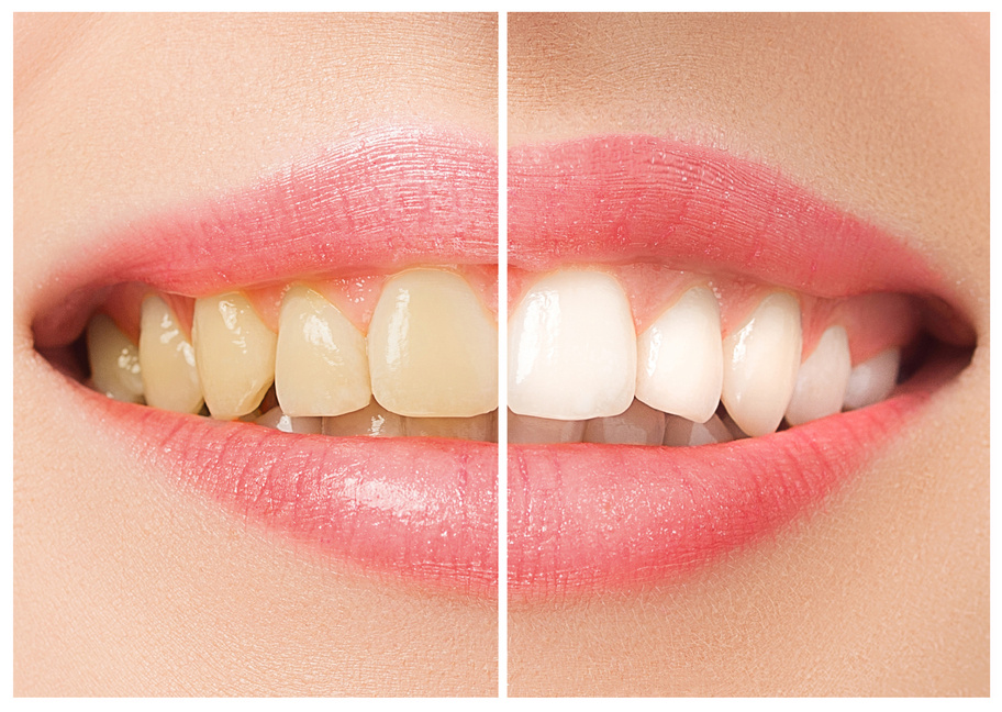 The female teeth before and after whitening